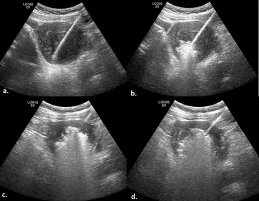 Ultrasound-Guided Percutaneous Microwave Ablation for the Treatment of Uterine Fibroids